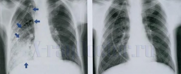 рентген легких при пневмонии